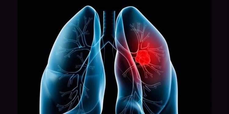 Επιστημονική Διημερίδα για τον Καρκίνο του Πνεύμονα: «Η Αναπνοή μας, Η Ζωή μας»